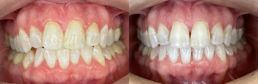 invisalign 1