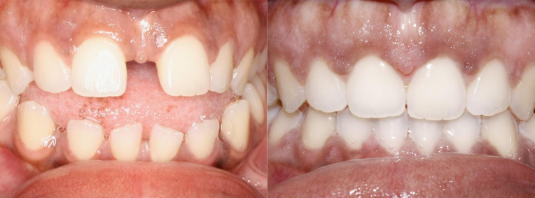 invisalign 6