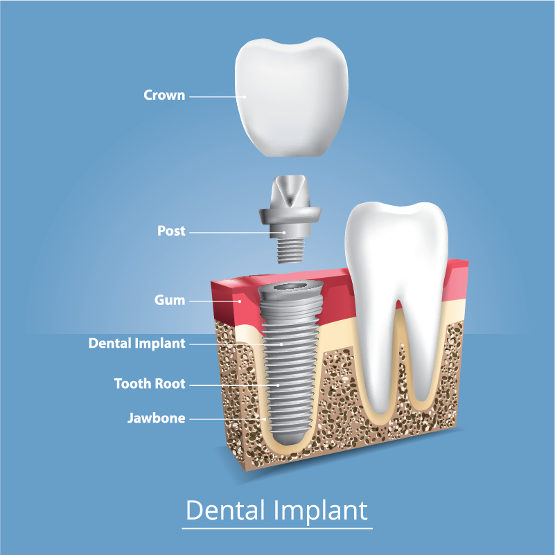 Implant Diagram