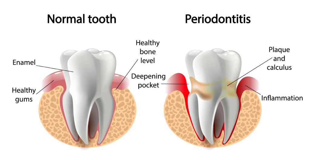 Periodontitis Diagram