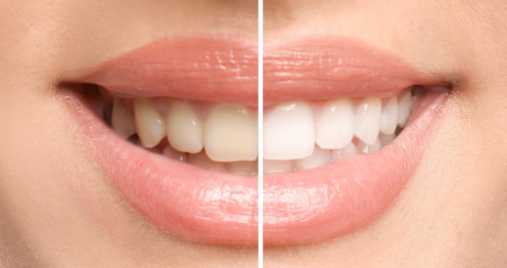 whitening before and after