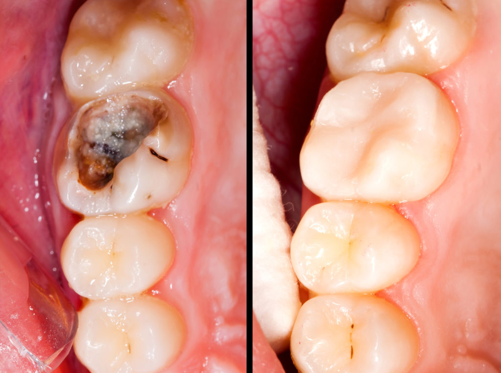 Crown Before and After